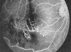 angiografia ocular